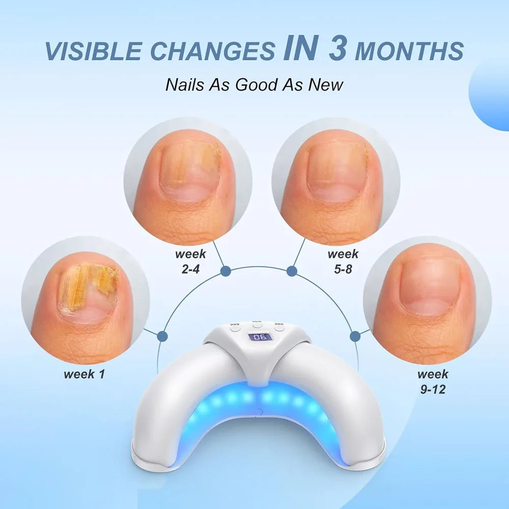 ClearNailz™ Fungal Nail Laser