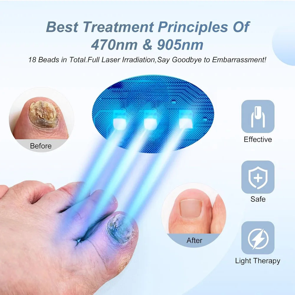 ClearNailz™ Fungal Nail Laser